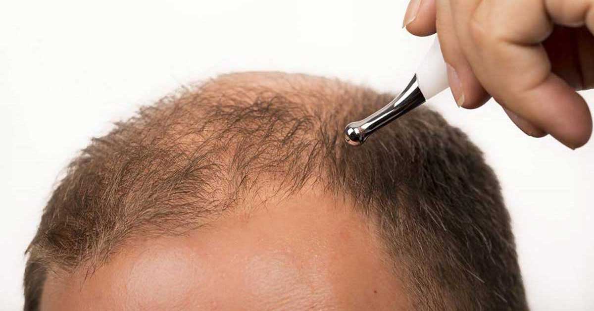 درمان ورم صورت بعد از کاشت مو