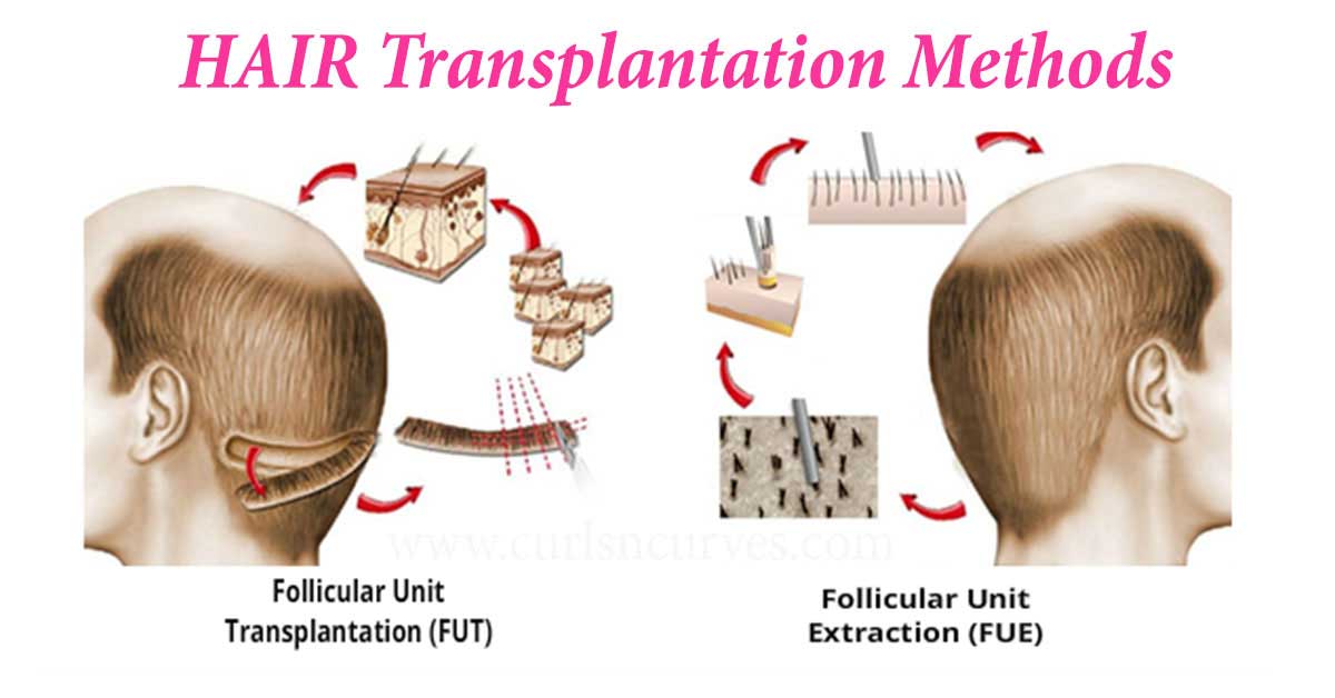Hair transplantation in bangalore