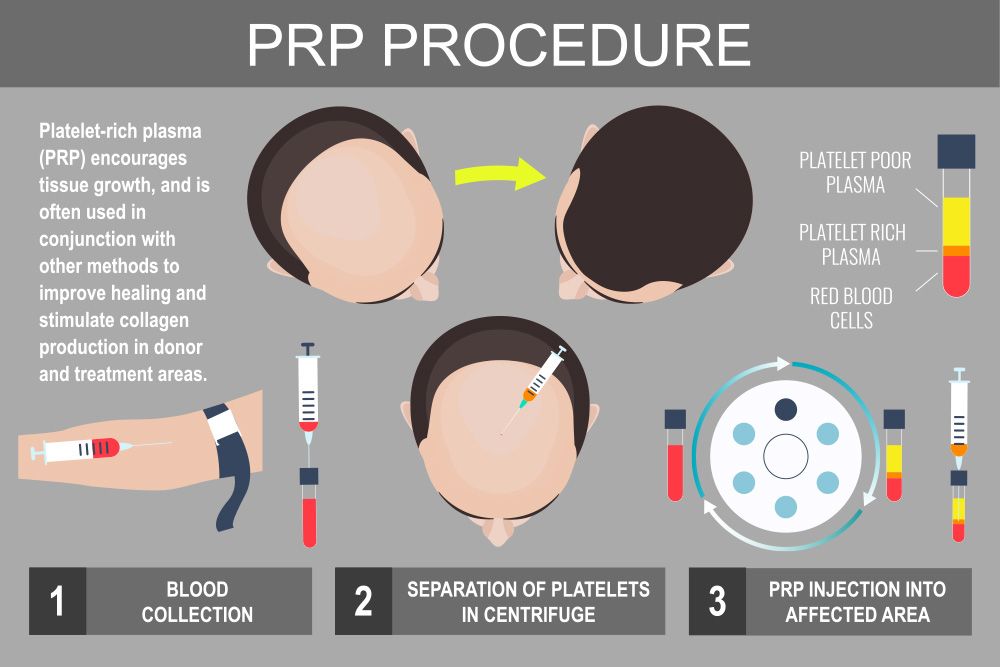 PRP Hairloss