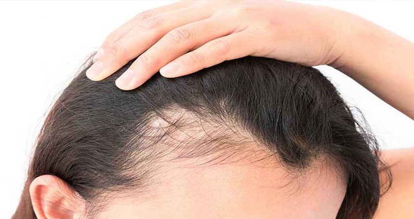 عوامل موثر برهزینه کاشت مو در پیشانی زنان