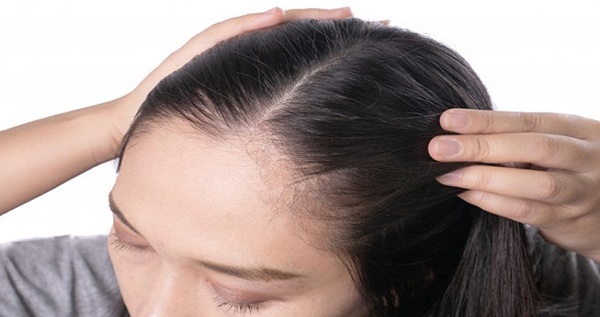 روش‌های کاشت مو در پیشانی زنان