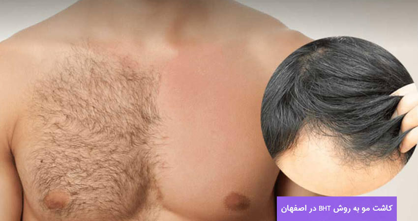 کاشت مو به روش BHT در اصفهان