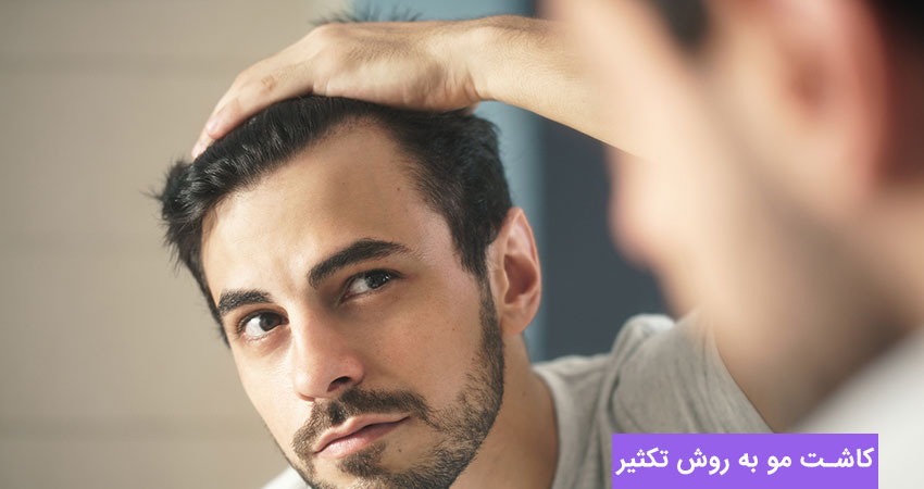 ویژگی های کاشت مو به روش تکثیر