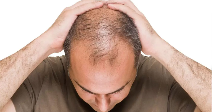  کاشت مو به روش سلول های بنیادی اصفهان