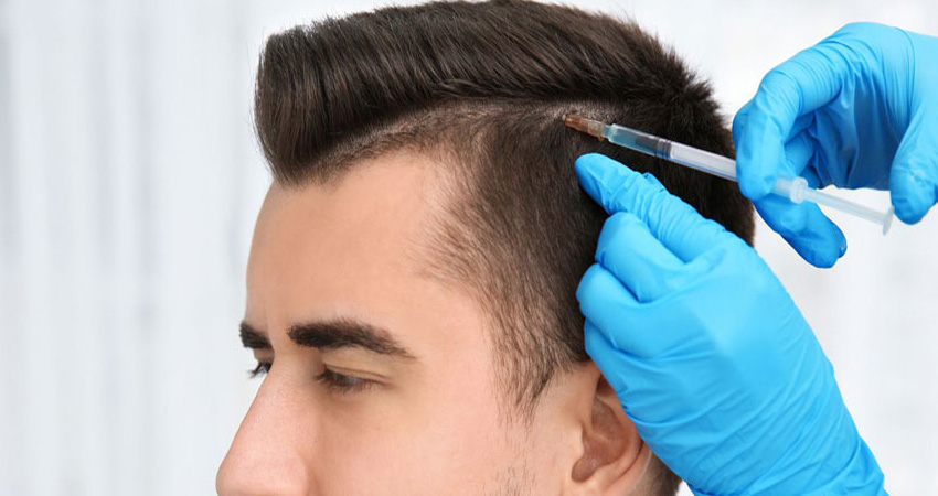 مراحل کاشت مو به روش سلول های بنیادی در اصفهان