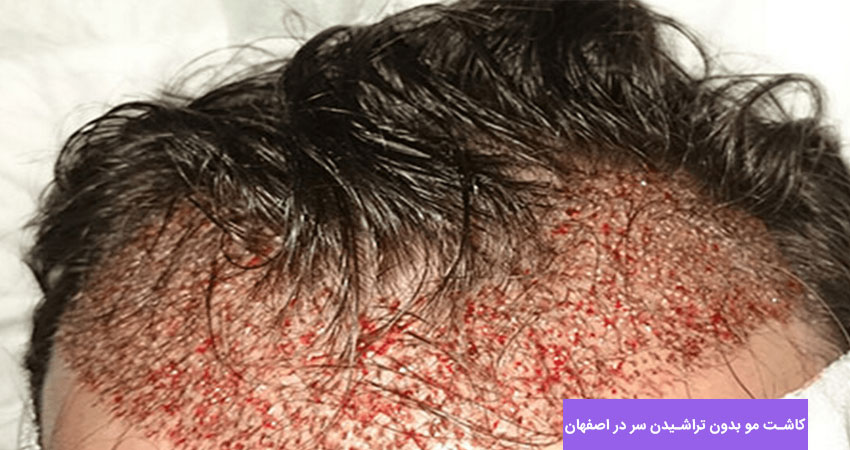 کاشت مو بدون تراشیدن سر اصفهان