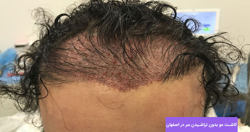چگونگی کاشت مو بدون تراشیدن سر در کلینیک اصفهان دکتر مسلمی