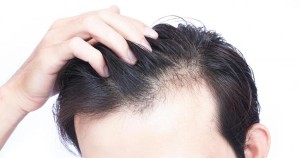 راه حل درمان خالی شدن فرق سر
