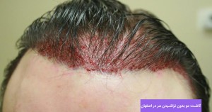 کاشت مو بدون تراشیدن سر در اصفهان