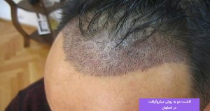 کاشت مو به روش میکروگرافت در اصفهان