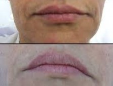 هایفوتراپی در اصفهان