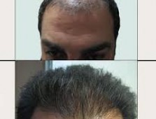 هزینه کاشت مو در اصفهان