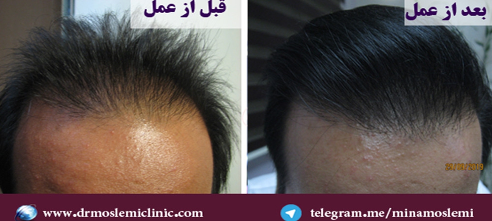 کاشت مو به روش sut در اصفهان