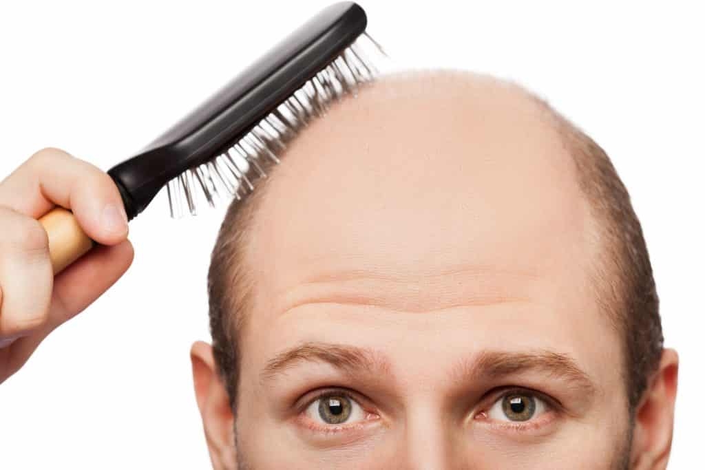  کاشت موی طبیعی چیست