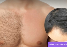کاشت مو به روش BHT در اصفهان