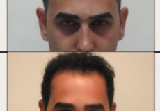 کاشت موی طبیعی در اصفهان
