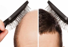 چه موهایی در سر برای کاشت مو استفاده می شود؟
