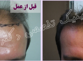 عکس کاشت مو قبل و بعد , تصاویر کاشت موی سر , عکس کاشت موی سر