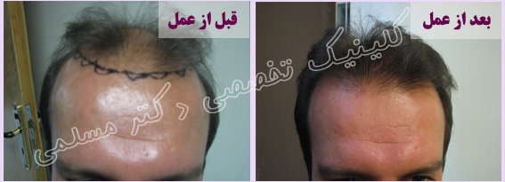 عکس کاشت مو قبل و بعد , تصاویر کاشت موی سر , عکس کاشت موی سر