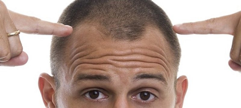 خالی شدن موی جلوی سر در الگوی ریزش موی مردانه